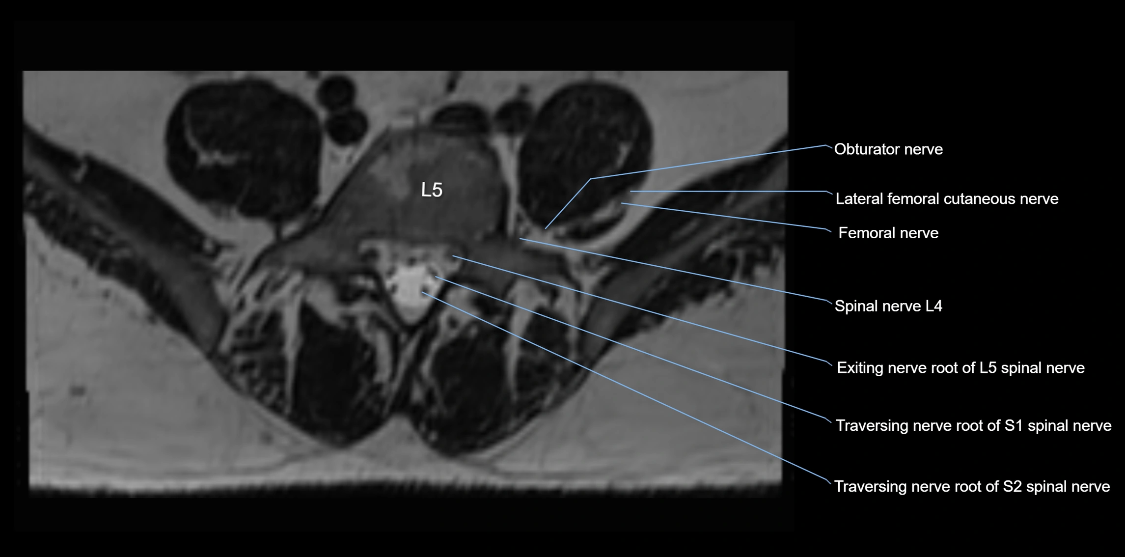MR lumbosacral plexus axial cross sectional anatomy 3T  radiology  image-img-1008001-00053.webp